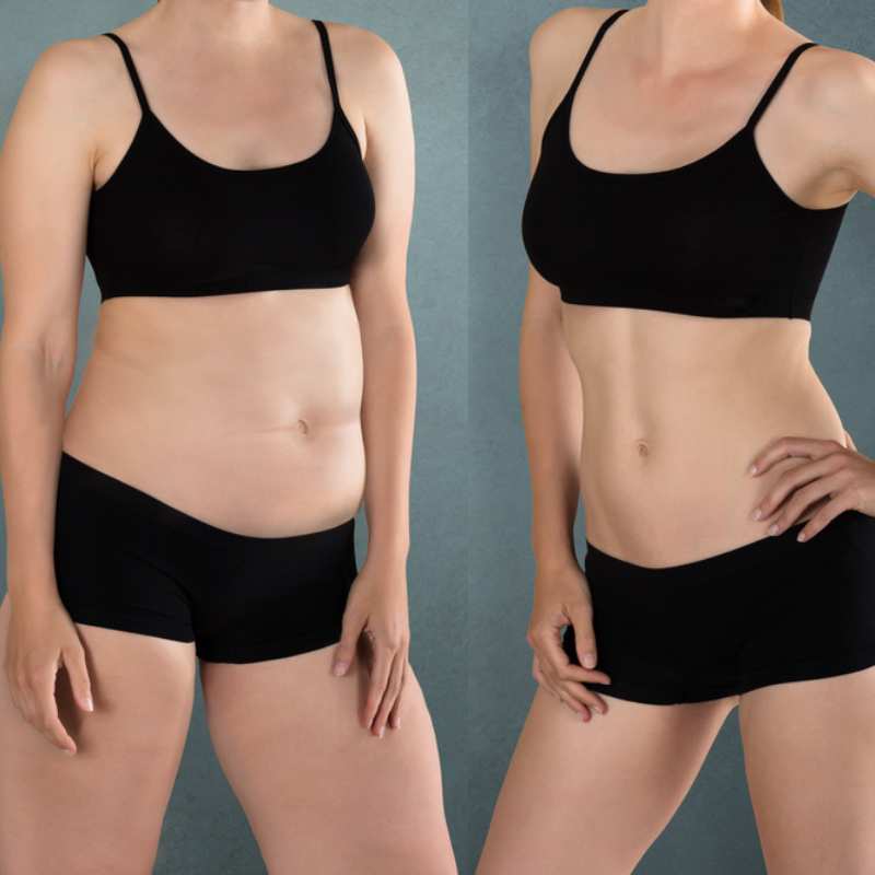 Does Fat Freezing at Home Work? DIY Devices vs Professional Cryolipolysis 2 before and after Cryolipolysis Newbury