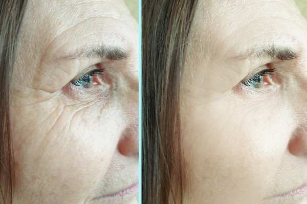 Why Do People Choose HIFU for a Non-Surgical Facelift? 4 How long can HIFU results last Newbury?