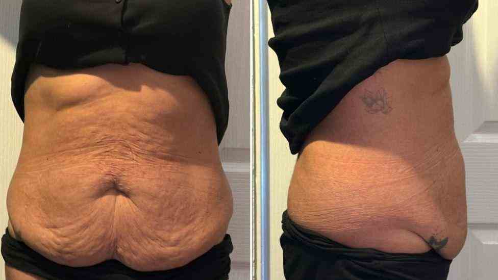 Lost the Weight but Not the Loose Skin? What You Should Know 1 Is It Definitely Loose Skin Newbury?